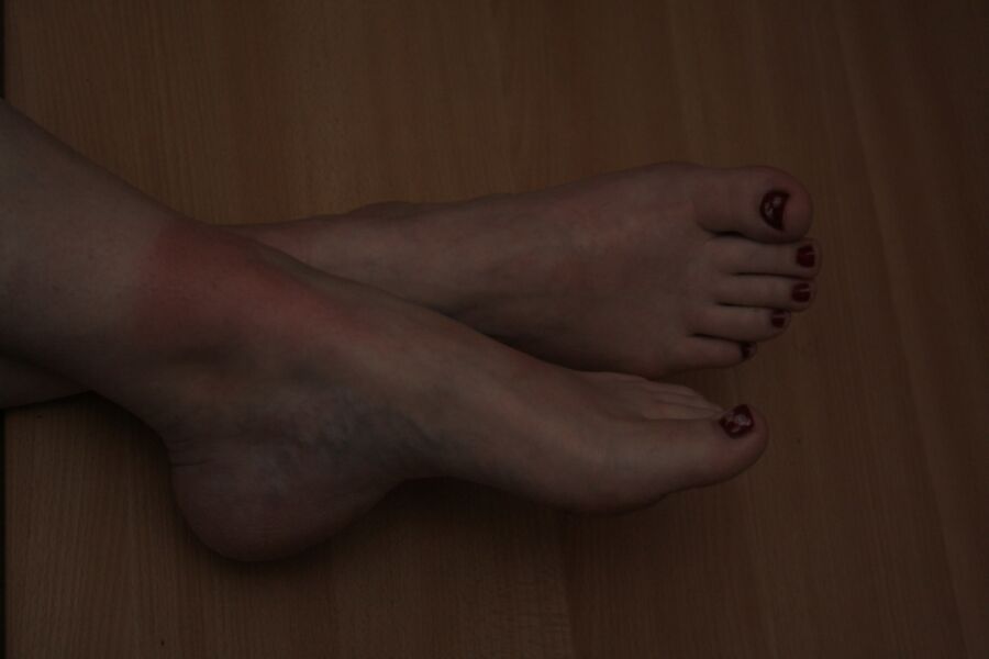 Free porn pics of sunburned feet 1 of 15 pics
