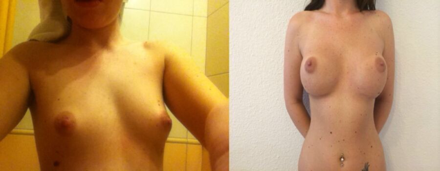 Free porn pics of German bitch fake tits before and after 3 of 28 pics