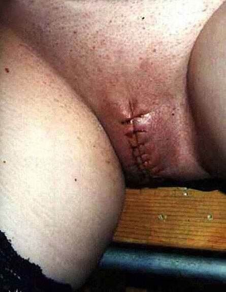 Free porn pics of Infibulation & Clitorectomy VI 12 of 48 pics