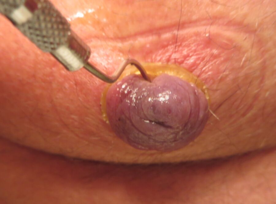 Free porn pics of sharp dental tool meets nipple 5 of 10 pics